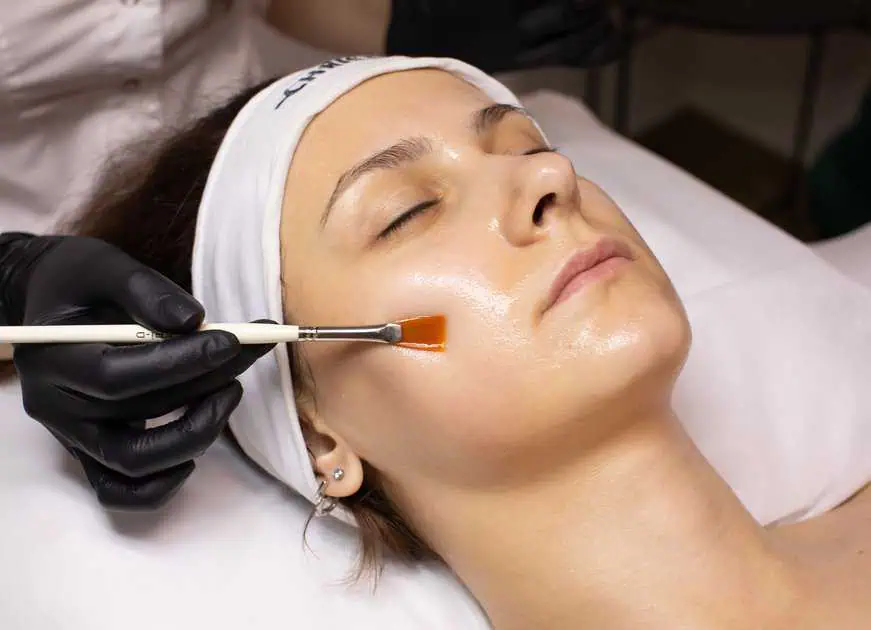 Chemical Peel Treatments in San Angelo by Beauty Abound Aesthetics