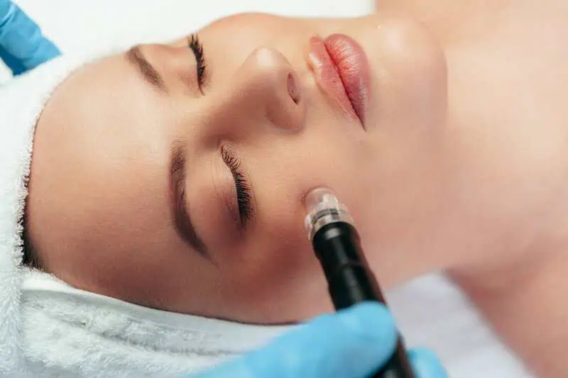 Microneedling